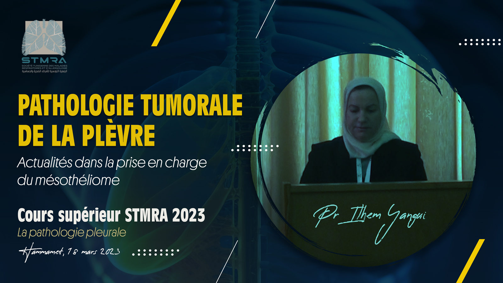 Actualités dans la prise en charge du mésothéliome